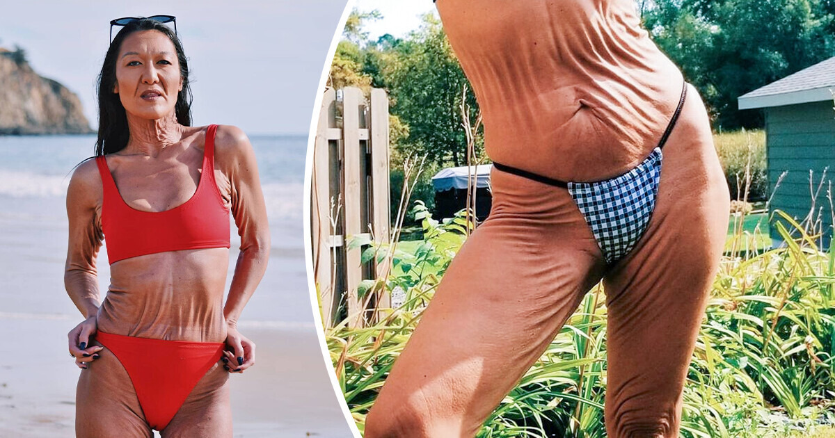 “Each Line Holds Beauty,” A Woman, 33, With a Rare Skin Condition Inspires People to Celebrate Their Uniqueness
