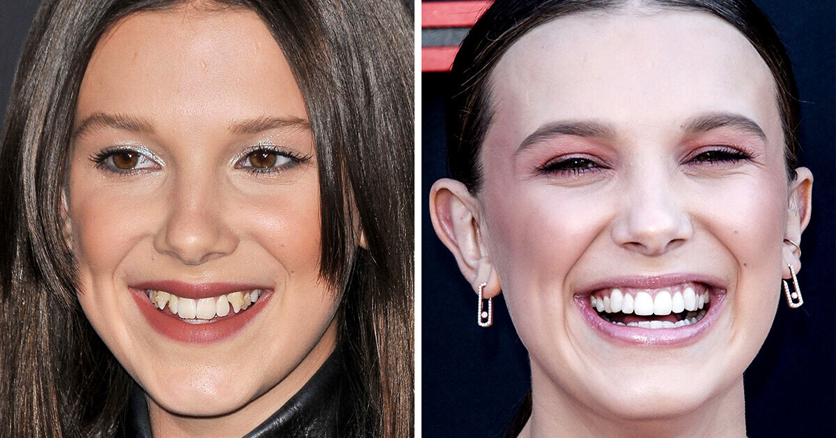 10 Stars Who Boosted Their Looks With New Teeth