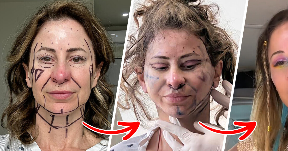 A Woman Sold Her HOUSE for a Beauty Procedure, Only to Face Mockery and Harsh Comments A Woman Sold Her HOUSE for a Beauty Procedure, Only to Face Mockery and Harsh Comments