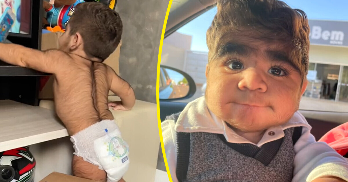 “He Looks 35”, Extremely Hairy Baby Boy Steals Hearts with His Unique Appearance “He Looks 35”, Extremely Hairy Baby Boy Steals Hearts with His Unique Appearance