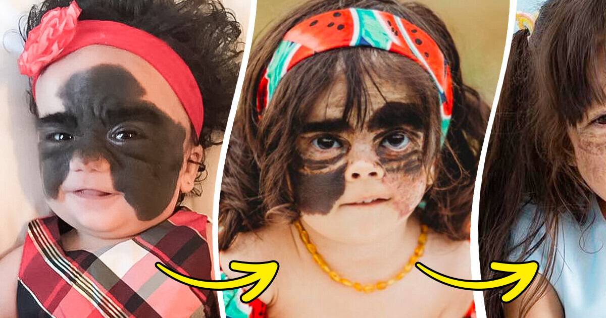 Girl with a “Batman” Birthmark Proves That True Beauty Is Within Girl with a “Batman” Birthmark Proves That True Beauty Is Within
