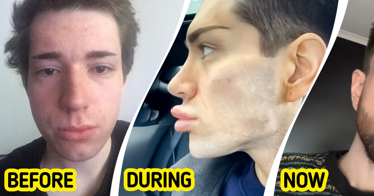A Man’s Plastic Surgery Results Cause a Stir Among Viewers A Man’s Plastic Surgery Results Cause a Stir Among Viewers