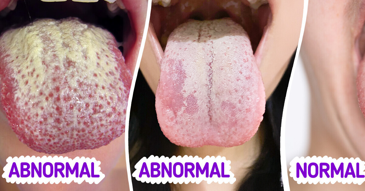 What White Tongue Means for Your Health and How to Treat It Naturally What White Tongue Means for Your Health and How to Treat It Naturally