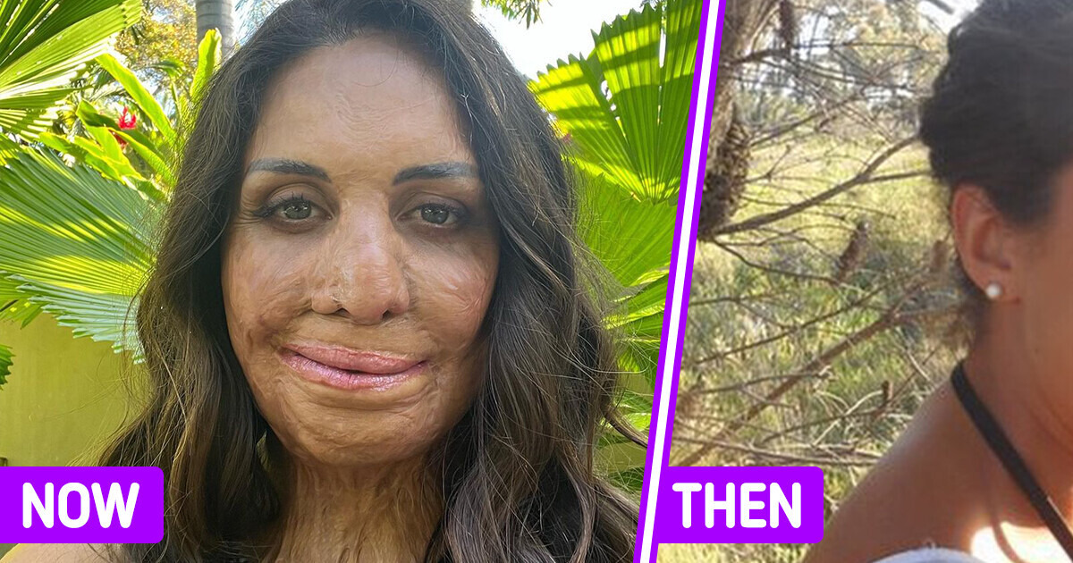 The Remarkable Story of Turia Pitt, Who Survived a Deadly Fire and Accepted a New Self With Her Husband’s Love The Remarkable Story of Turia Pitt, Who Survived a Deadly Fire and Accepted a New Self With Her Husband’s Love