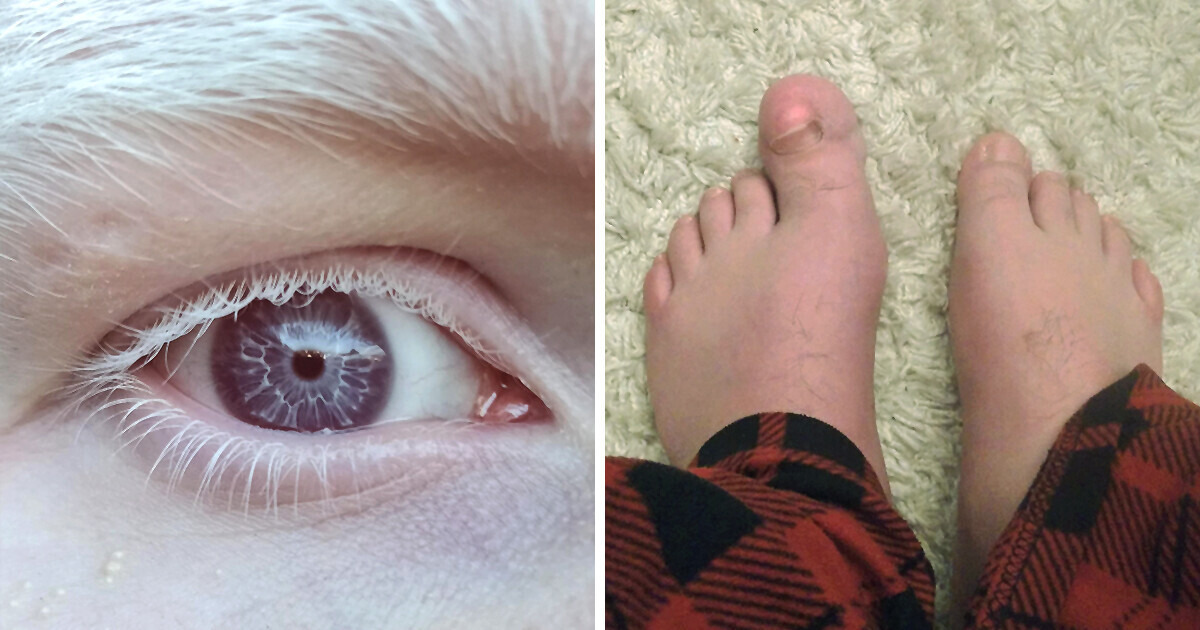 15 Lucky Ones Who Were Gifted With Unique Features by Nature