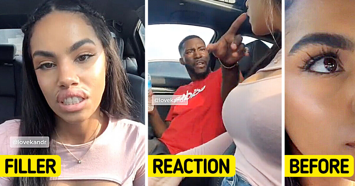 Woman Pranked Her Partner With Lip Filler, But She Definitely Didn’t Expect Such Response Woman Pranked Her Partner With Lip Filler, But She Definitely Didn’t Expect Such Response
