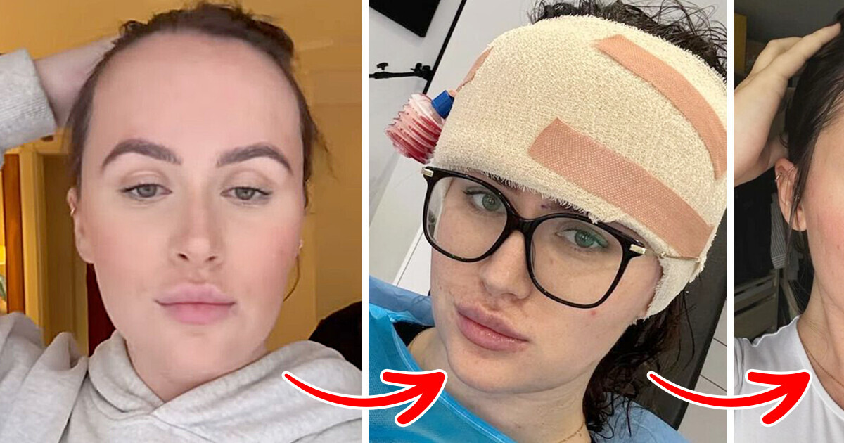 The Woman Was Bullied in School for Her Large Forehead, so She ...