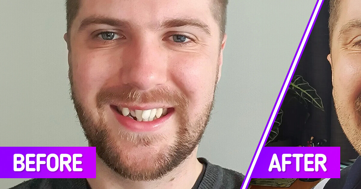12 People Who Completed Their Journey to a New Smile and Now They Look Completely Different