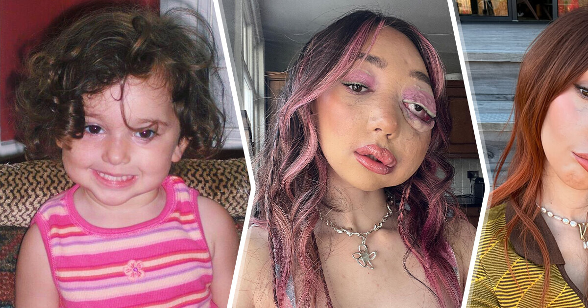 Young Woman with Unique Facial Condition Seizes Every Opportunity to Advocate for Embracing Visible Differences Young Woman with Unique Facial Condition Seizes Every Opportunity to Advocate for Embracing Visible Differences