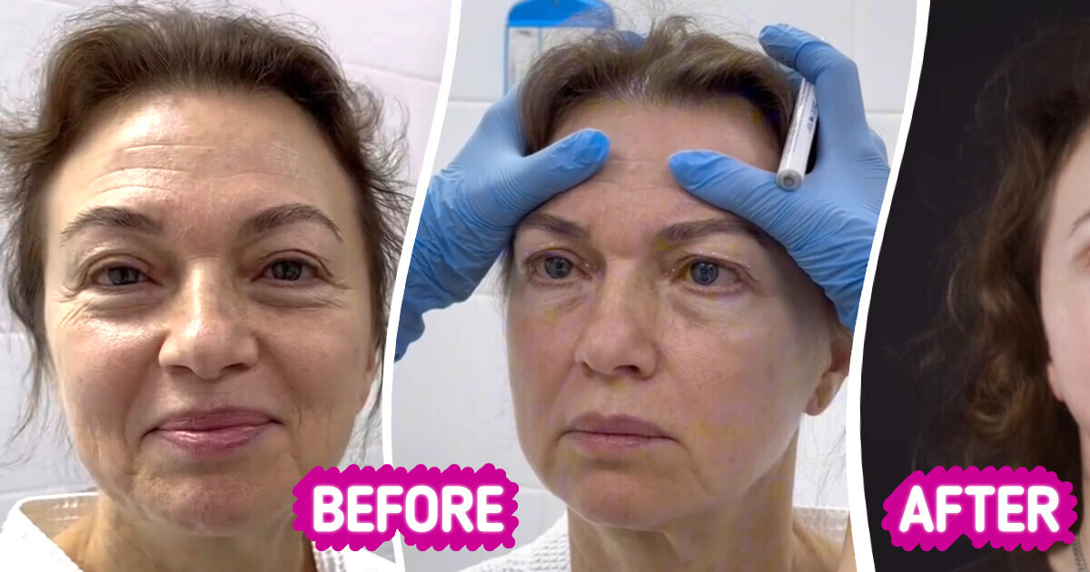 “She Looks 30!” A 58-Year-Old Woman Underwent a Facelift, Leaving Everyone in Awe “She Looks 30!” A 58-Year-Old Woman Underwent a Facelift, Leaving Everyone in Awe