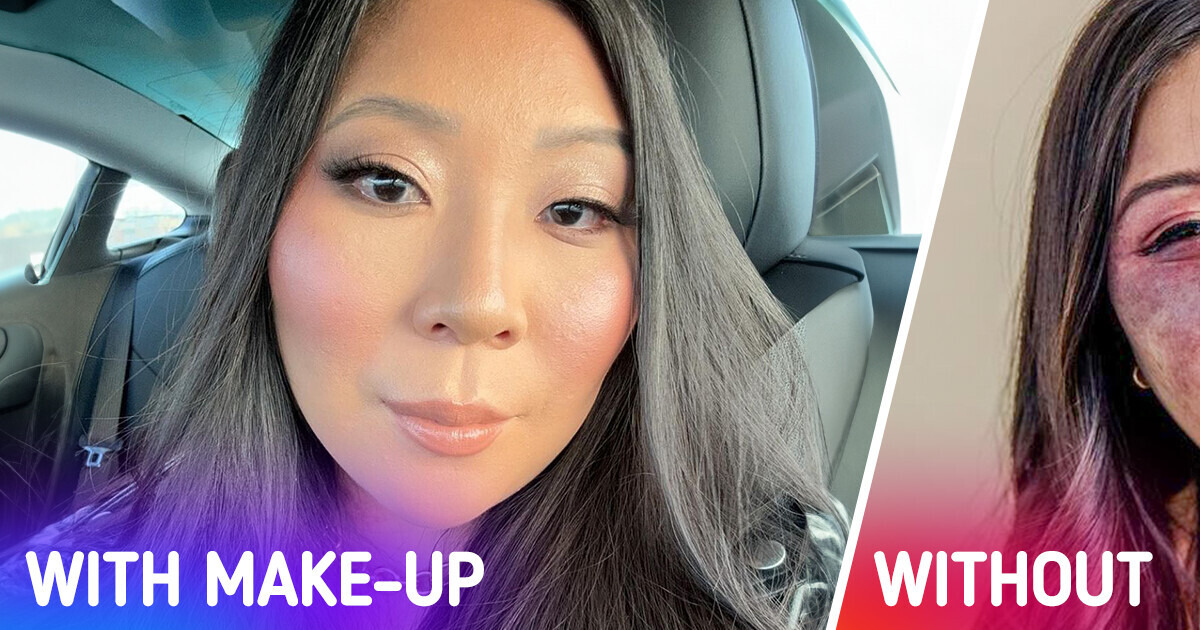 A Woman with a Large Facial Birthmark Reveals What It’s Like When People Are Always Staring at You A Woman with a Large Facial Birthmark Reveals What It’s Like When People Are Always Staring at You