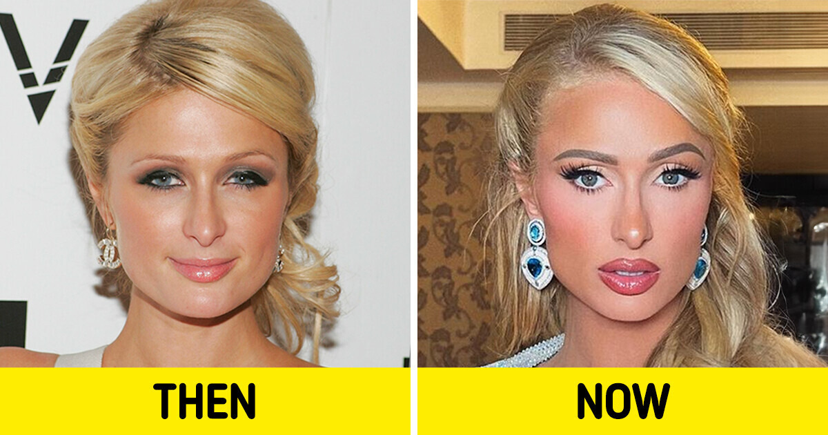 Paris Hilton Explains Why She Has Never Done Botox in Her Life
