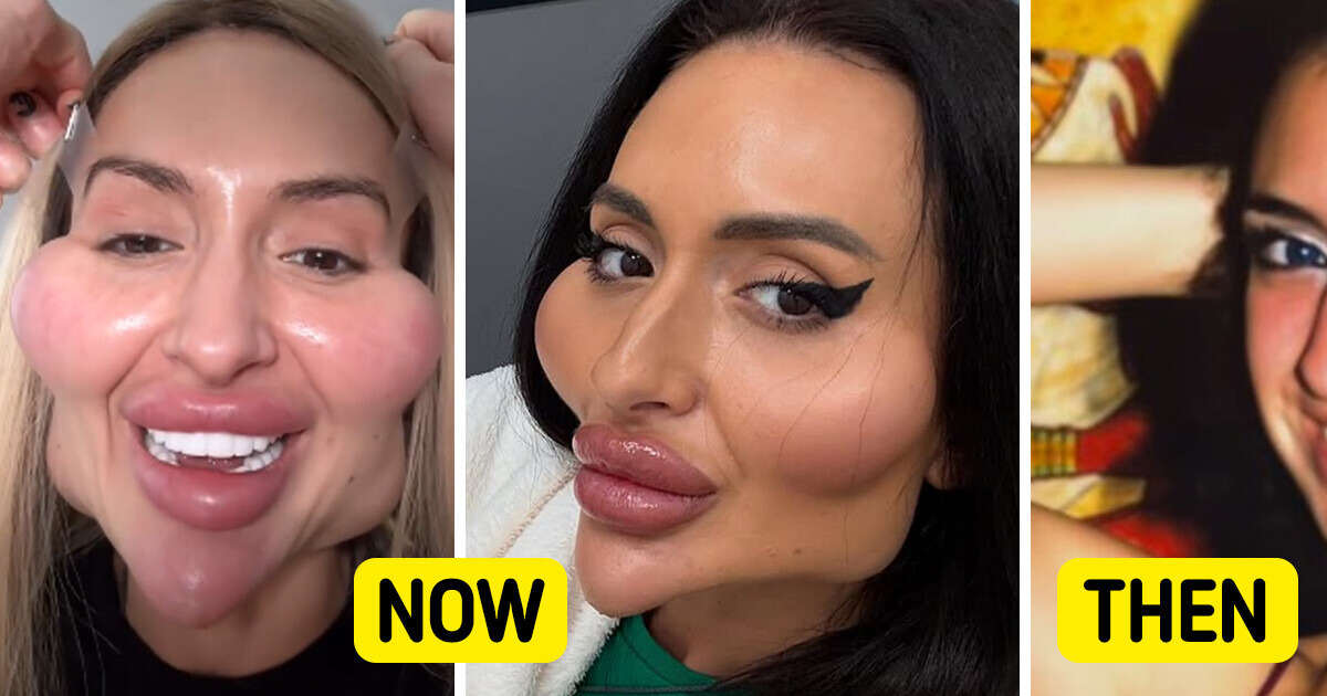 Unseen Before Photo of the Woman With the “Biggest Cheeks in the World” Leaves People in Awe Unseen Before Photo of the Woman With the “Biggest Cheeks in the World” Leaves People in Awe
