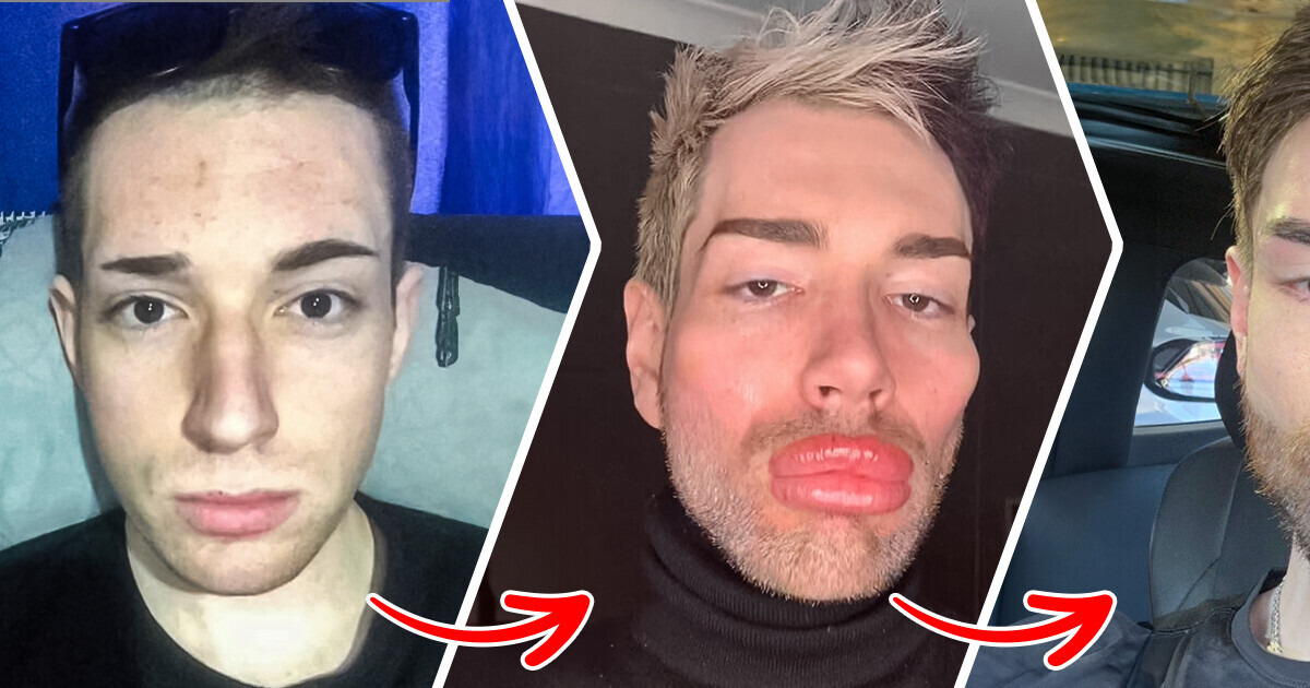 A Man Removed 13 Ml of Facial Fillers, Leaving Everyone Thrilled With His New Look A Man Removed 13 Ml of Facial Fillers, Leaving Everyone Thrilled With His New Look