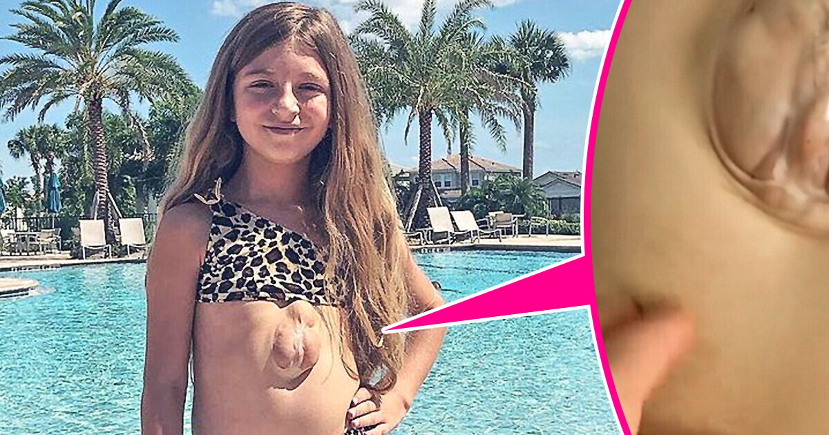 This Girl Was Born With Her Heart Outside Her Chest, Challenging Doctors Who Gave Her No Chance To Live Even for a Day