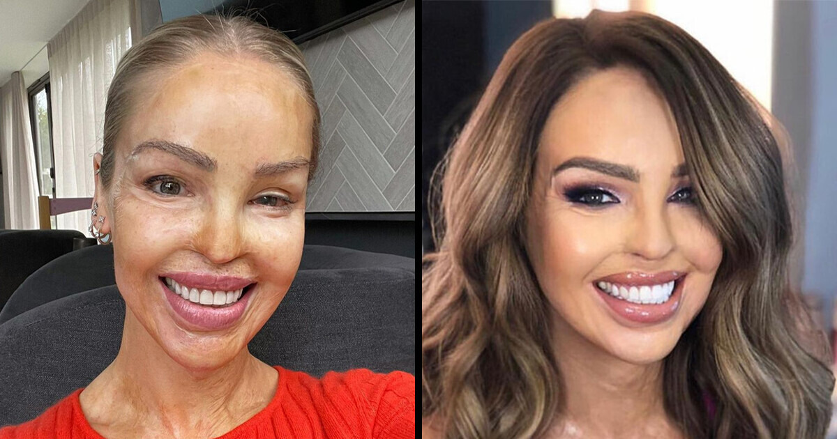 Katie Piper’s Inspiring Journey of Recovery After an Acid Attack Katie Piper’s Inspiring Journey of Recovery After an Acid Attack