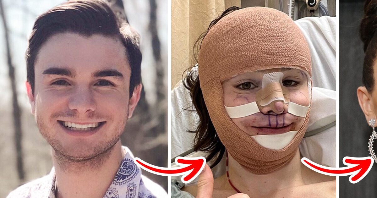 Dylan Mulvaney’s Inspiring Journey Through Facial Feminization To ...