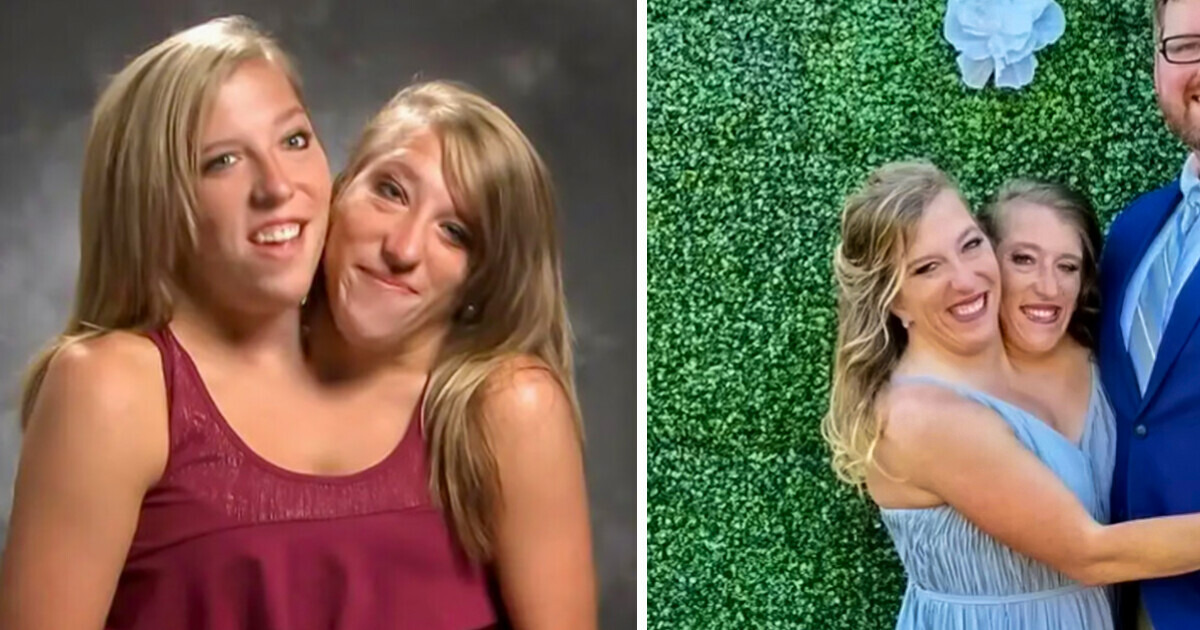 One of the Conjoined Twins Got Married, and People Had Many Questions About It One of the Conjoined Twins Got Married, and People Had Many Questions About It