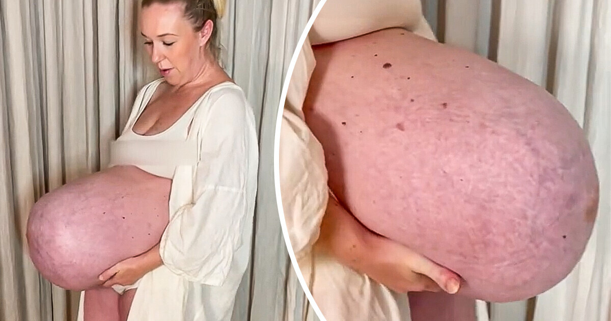 “How is That Possible?”: Mom’s Giant Baby Bump That Goes “Straight Out” Leaves People Confused “How is That Possible?”: Mom’s Giant Baby Bump That Goes “Straight Out” Leaves People Confused