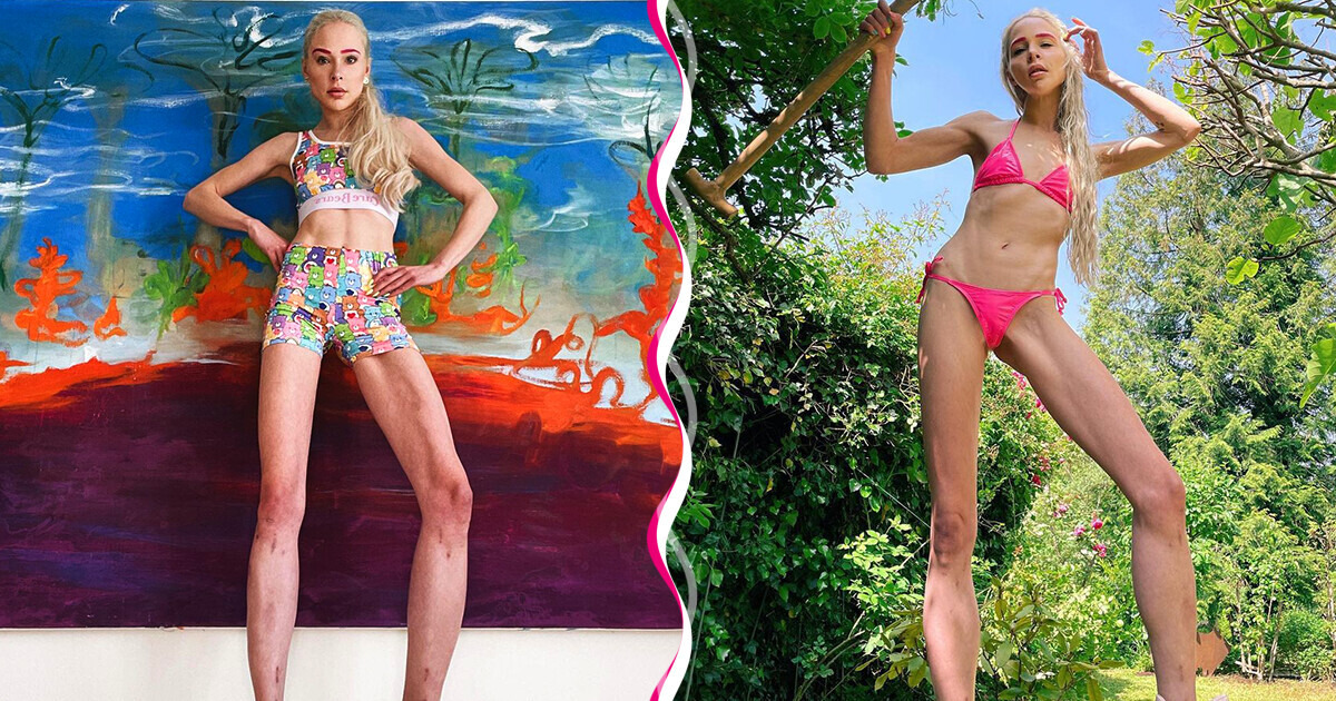 Woman Spent £130k on Leg-Lengthening Surgery Due to Her Husband’s Hurtful Remarks, and Now She’s Filled with Regret Woman Spent £130k on Leg-Lengthening Surgery Due to Her Husband’s Hurtful Remarks, and Now She’s Filled with Regret