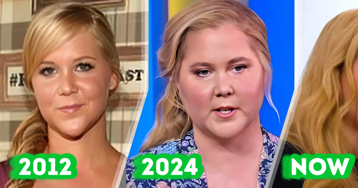 Amy Schumer Reveals Internet Trolls Helped Her Discover She Had Cushing’s Syndrome Amy Schumer Reveals Internet Trolls Helped Her Discover She Had Cushing’s Syndrome