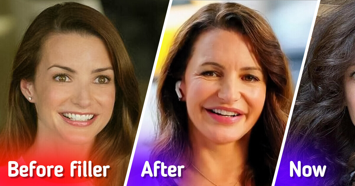 Kristin Davis, 59, Dissolved Fillers in Her Face, Leaving People in Awe ...