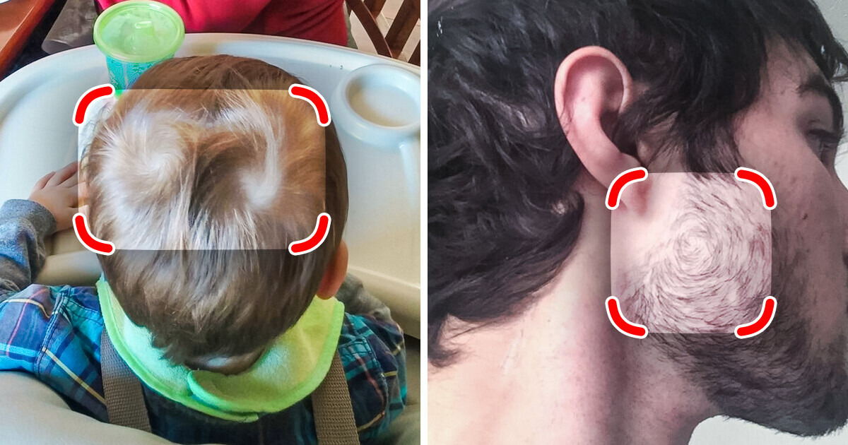 15 People Who Were Born With Special Body Features To Make Them One-of-a-kind