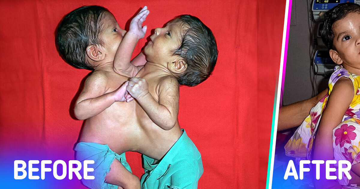 The Exceptional Story of the Conjoined Twins Who Were Separated After a 12-Hour Risky Surgery The Exceptional Story of the Conjoined Twins Who Were Separated After a 12-Hour Risky Surgery