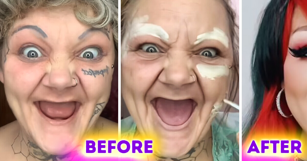 A 38-Year-Old Woman Undergone a Challenging Journey, Having to Remove Her Teeth, but Her Transformation Left People in Awe A 38-Year-Old Woman Undergone a Challenging Journey, Having to Remove Her Teeth, but Her Transformation Left People in Awe