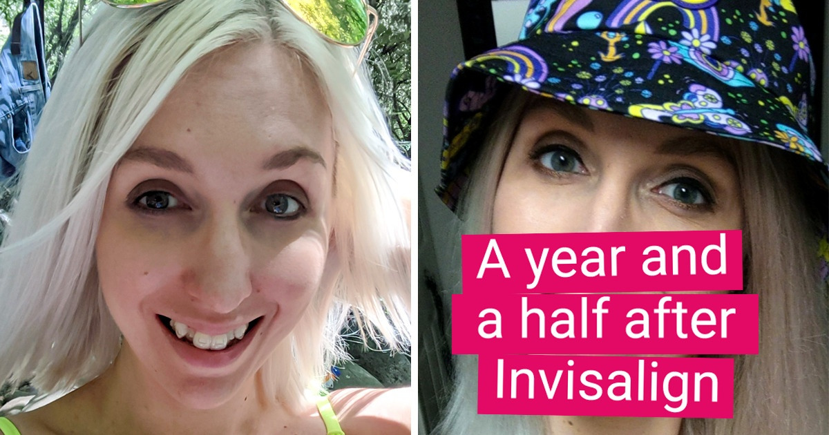 15 People Whose Self-esteem Skyrocketed After Fixing Their Teeth   Now 