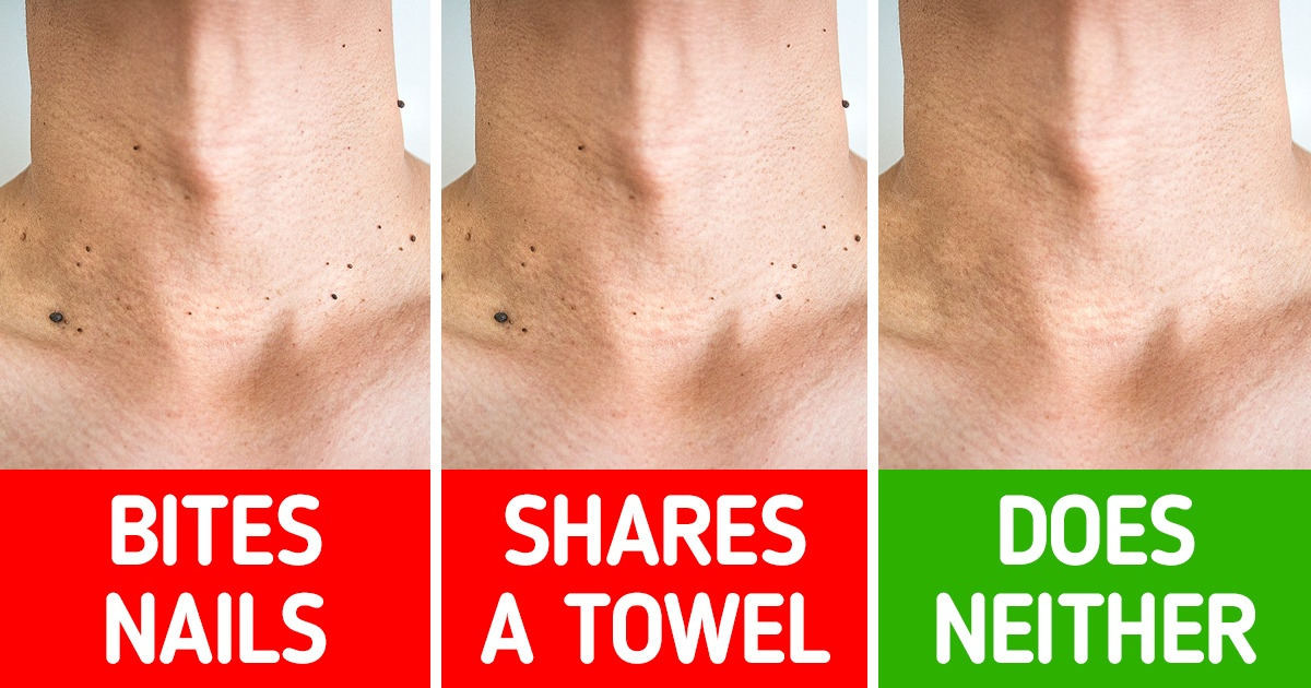 7 Effective Ways to Prevent Warts from Happening