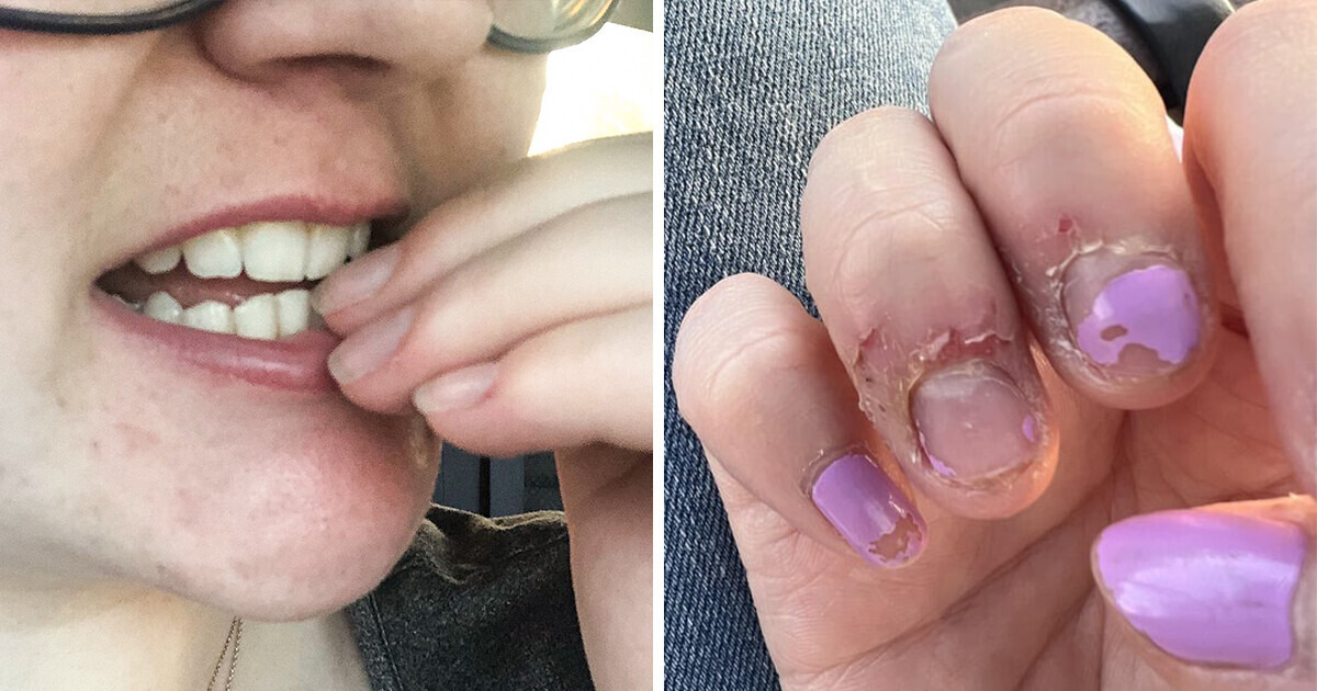 10 Effective Ways to Stop Biting Your Nails