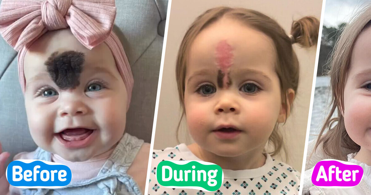 “People Would Stare at Her”, Parents Sent Daughter to Surgery to Remove Rare Birthmark Due to Fear of Mockery “People Would Stare at Her”, Parents Sent Daughter to Surgery to Remove Rare Birthmark Due to Fear of Mockery
