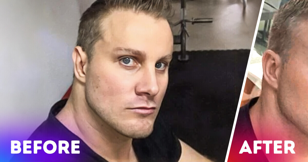 16 People Who Opted for Plastic Surgery, but Regretted It Once They Saw the Results 16 People Who Opted for Plastic Surgery, but Regretted It Once They Saw the Results