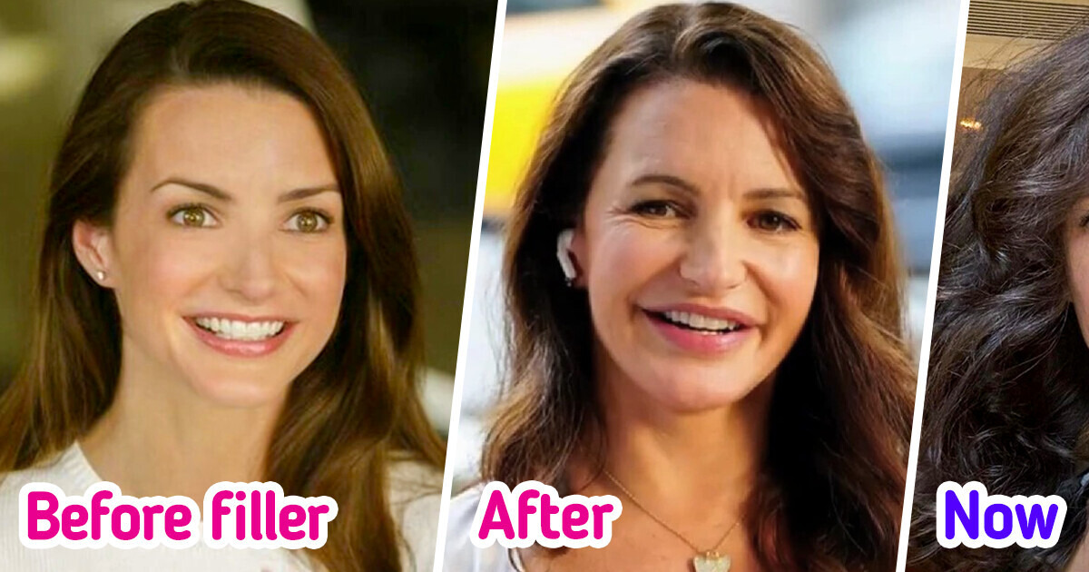 7 Celebrities Who Dissolved Their Fillers and Surprised Many with Their New Look 7 Celebrities Who Dissolved Their Fillers and Surprised Many with Their New Look
