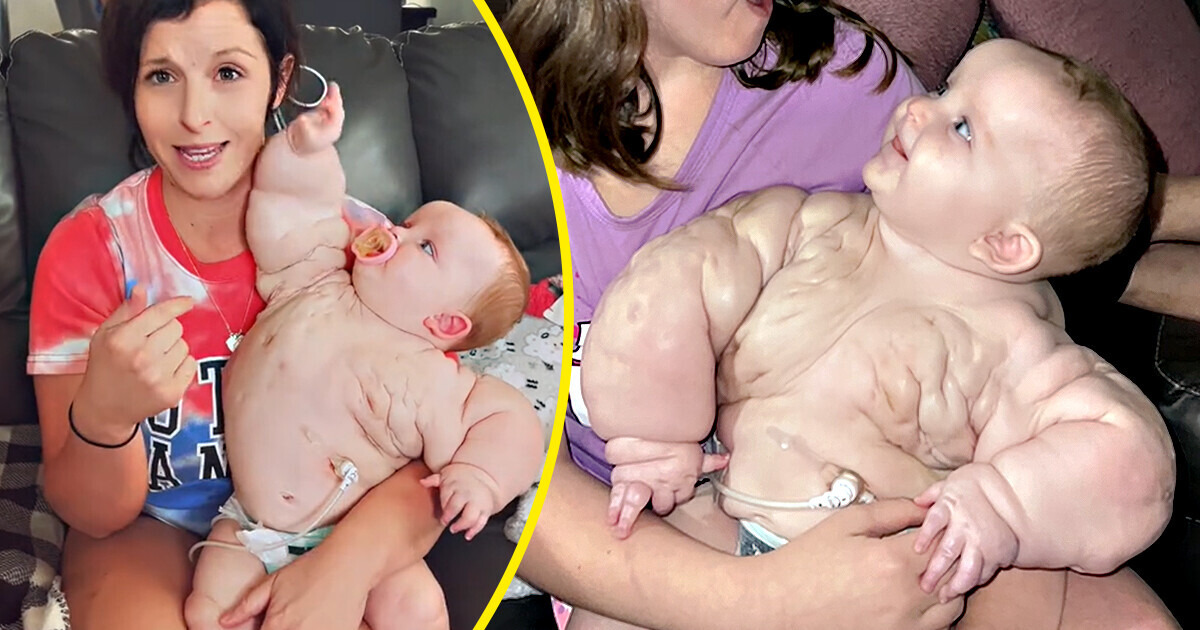 The Remarkable Story of “Baby Hulk,” the Newborn Girl Who Survived Against All Odds and Doctors’ Predictions
