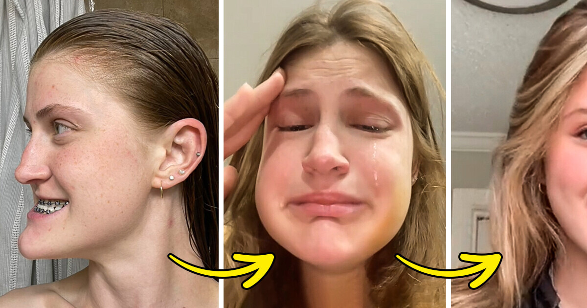 Young Woman Underwent Double Jaw Surgery and Got Her Braces Removed, Leaving Everyone Amazed by Her Stunning Transformation Young Woman Underwent Double Jaw Surgery and Got Her Braces Removed, Leaving Everyone Amazed by Her Stunning Transformation