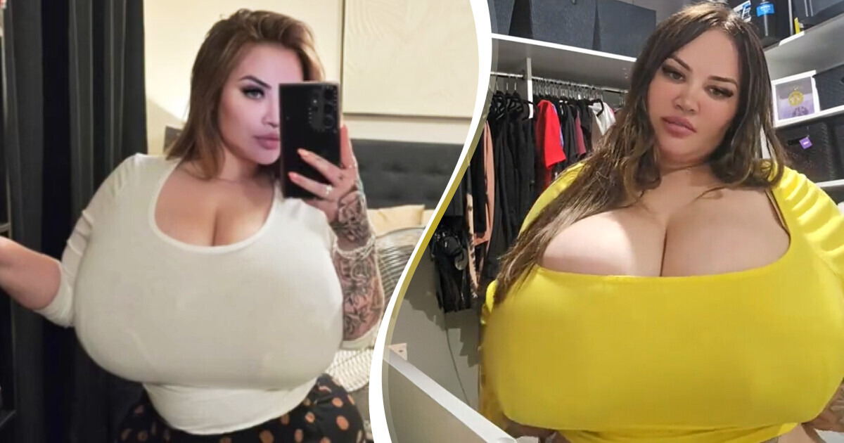 A Woman with Rare Condition Spends a Fortune on Bras as Her Breasts Continue to Grow A Woman with Rare Condition Spends a Fortune on Bras as Her Breasts Continue to Grow