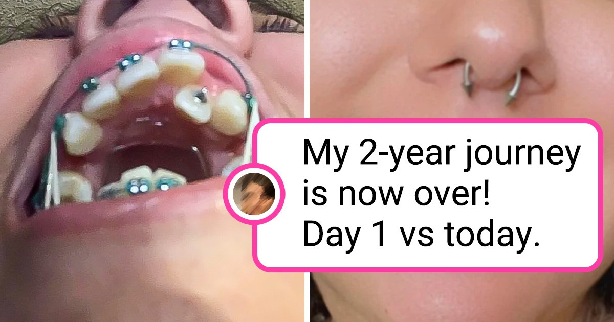 15 People Who Were So Thrilled to Share Their Teeth Progress 15 People Who Were So Thrilled to Share Their Teeth Progress