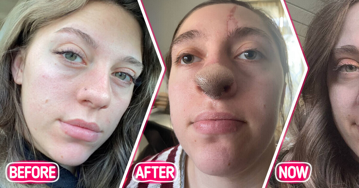 Young Woman Got Mauled by the Family Dog, Causing Hair to Grow on Her Nose