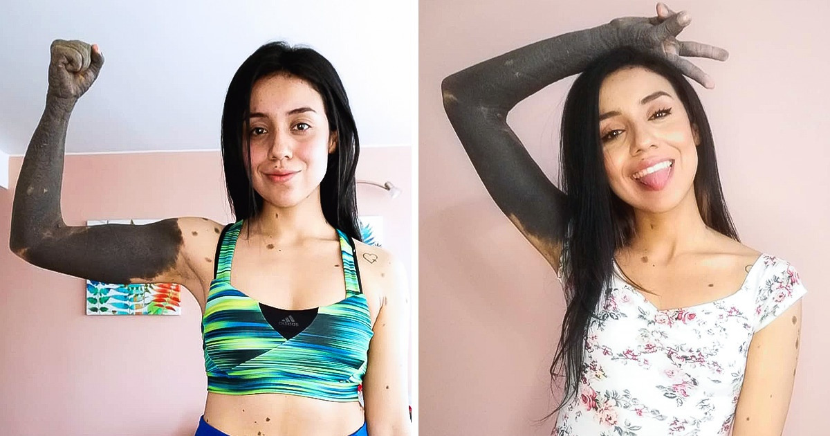 A Girl Covered in Birthmarks Overcame Difficulties, Found Her True Love, and Left Us in Tears With Her Story