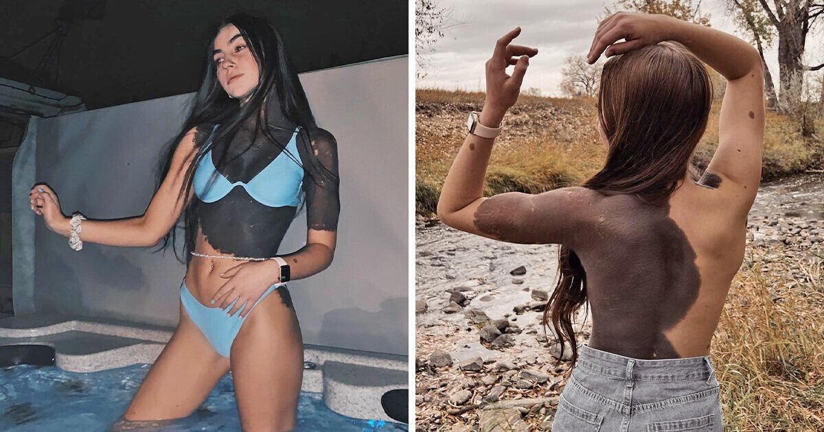 «Did you color on yourself?» Woman With Giant Birthmark Got Questioned All the Time and Now She Inspires People «Did you color on yourself?» Woman With Giant Birthmark Got Questioned All the Time and Now She Inspires People