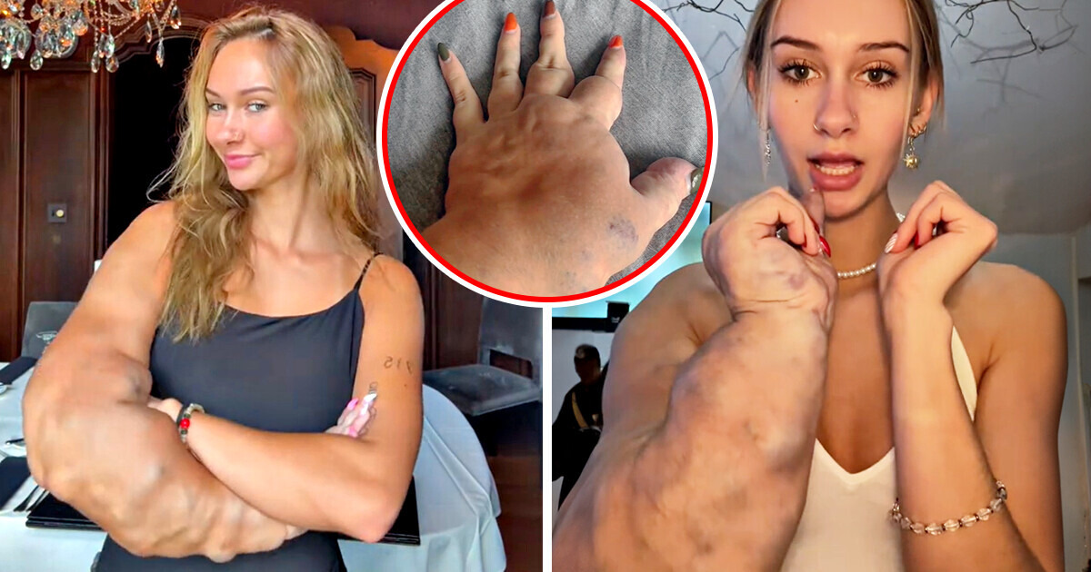 A Young Woman Nicknamed “Hulk” Due to Rare Condition Delivers Perfect Response to Trolls A Young Woman Nicknamed “Hulk” Due to Rare Condition Delivers Perfect Response to Trolls