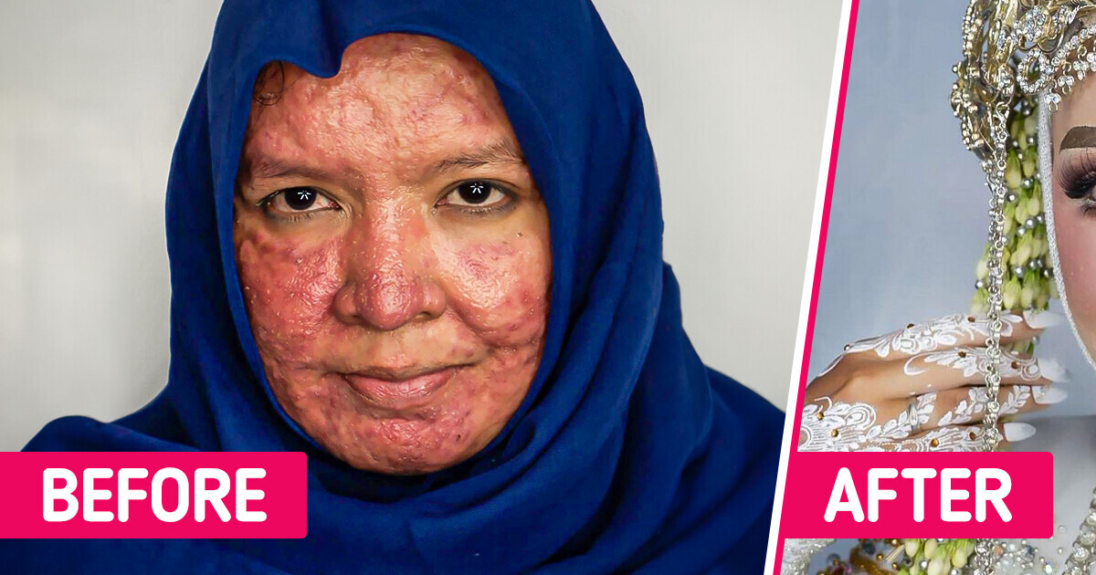 A Makeup Artist Transforms a Bride’s Face With Acne, and the Result Is Absolutely Astounding A Makeup Artist Transforms a Bride’s Face With Acne, and the Result Is Absolutely Astounding
