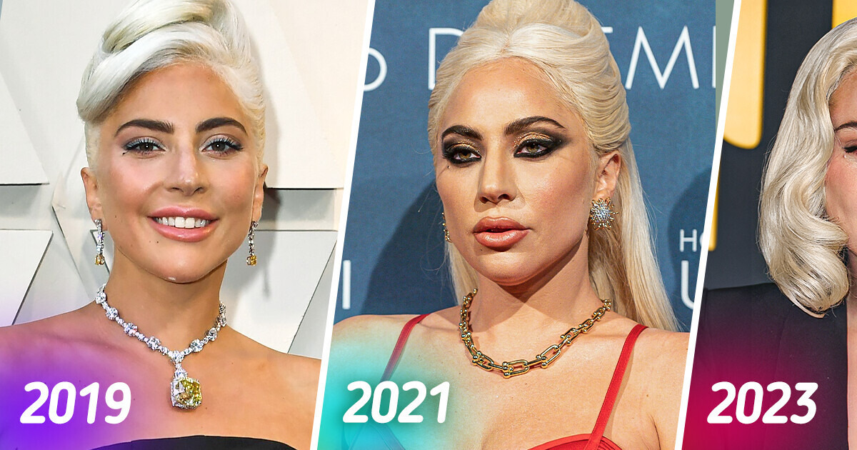 Lady Gaga’s Latest Appearance Sparks Heated Controversy and Raises Suggestions of Botox Abuse Lady Gaga’s Latest Appearance Sparks Heated Controversy and Raises Suggestions of Botox Abuse