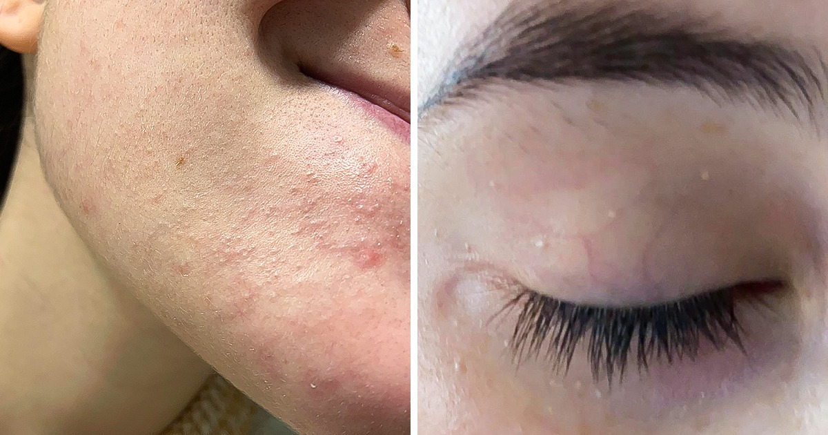 How to Treat Those White Bumps That Keep Popping Up on Your Face How to Treat Those White Bumps That Keep Popping Up on Your Face