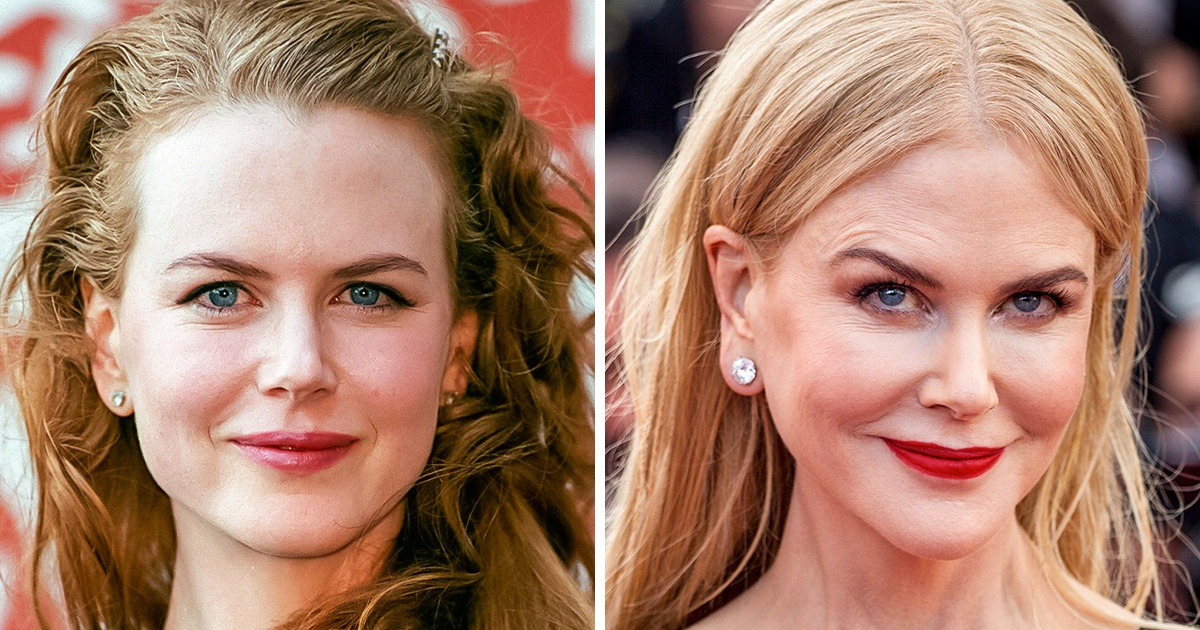 10+ Celebs Who Look Very Different After Cosmetic Procedures 10+ Celebs Who Look Very Different After Cosmetic Procedures