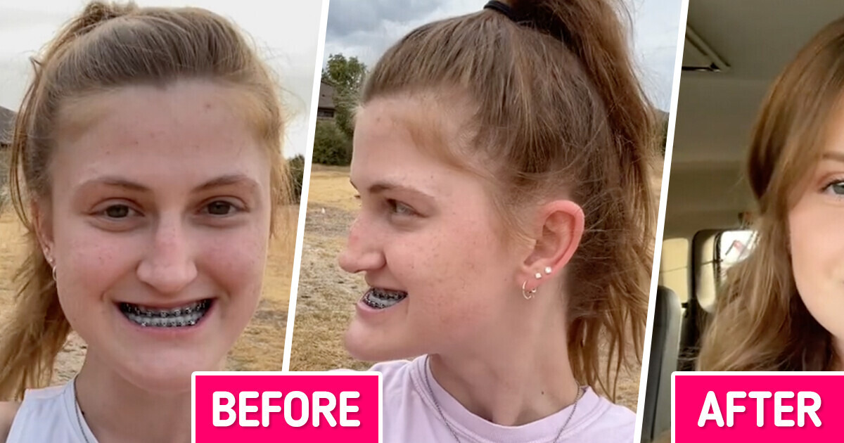TikTokker Documents Double Jaw Surgery and Wows the World TikTokker Documents Double Jaw Surgery and Wows the World