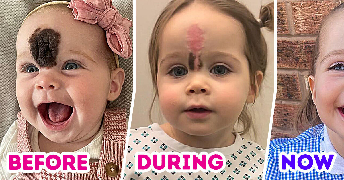 “We Got Stares,” Parents Dare to Remove Their Daughter’s Unusual Birthmark Due to Fear of Mockery “We Got Stares,” Parents Dare to Remove Their Daughter’s Unusual Birthmark Due to Fear of Mockery