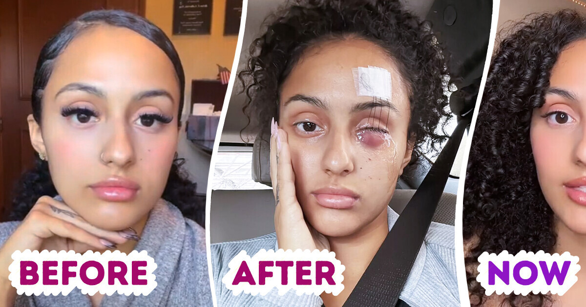 “I Still Don’t Believe It’s True,” Woman Loses Her Eye Because of a Dog Leash — Now She Warns People About Hidden Dangers “I Still Don’t Believe It’s True,” Woman Loses Her Eye Because of a Dog Leash — Now She Warns People About Hidden Dangers